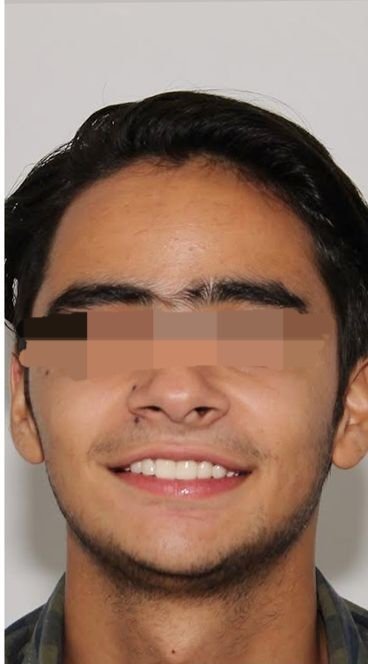 After smile transformation at Avi Dental Care