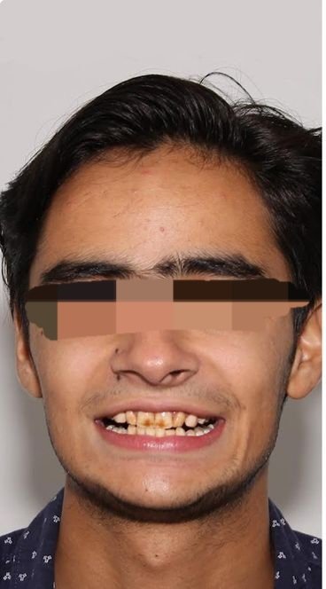 Before smile transformation at Avi Dental Care