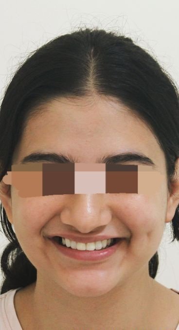 After smile transformation at Avi Dental Care