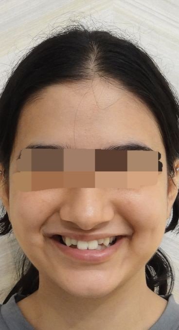 Before smile transformation at Avi Dental Care