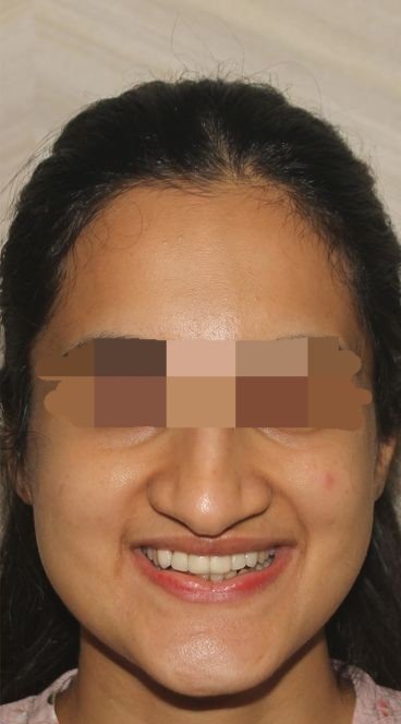 After smile transformation at Avi Dental Care