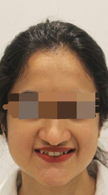 Before smile transformation at Avi Dental Care